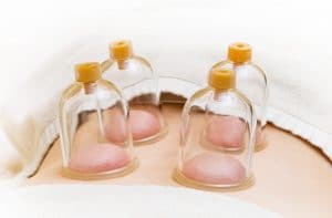 Cupping therapy for high blood pressure