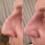 Before and After Nose Job