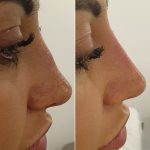 Before and After Liquid Rhinoplasty