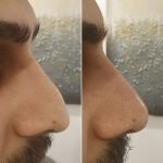 Before After Rhinoplasty