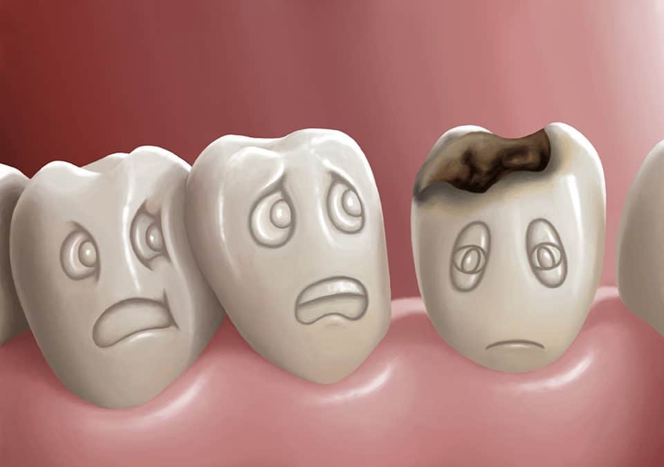 Cavities and Tooth Decay