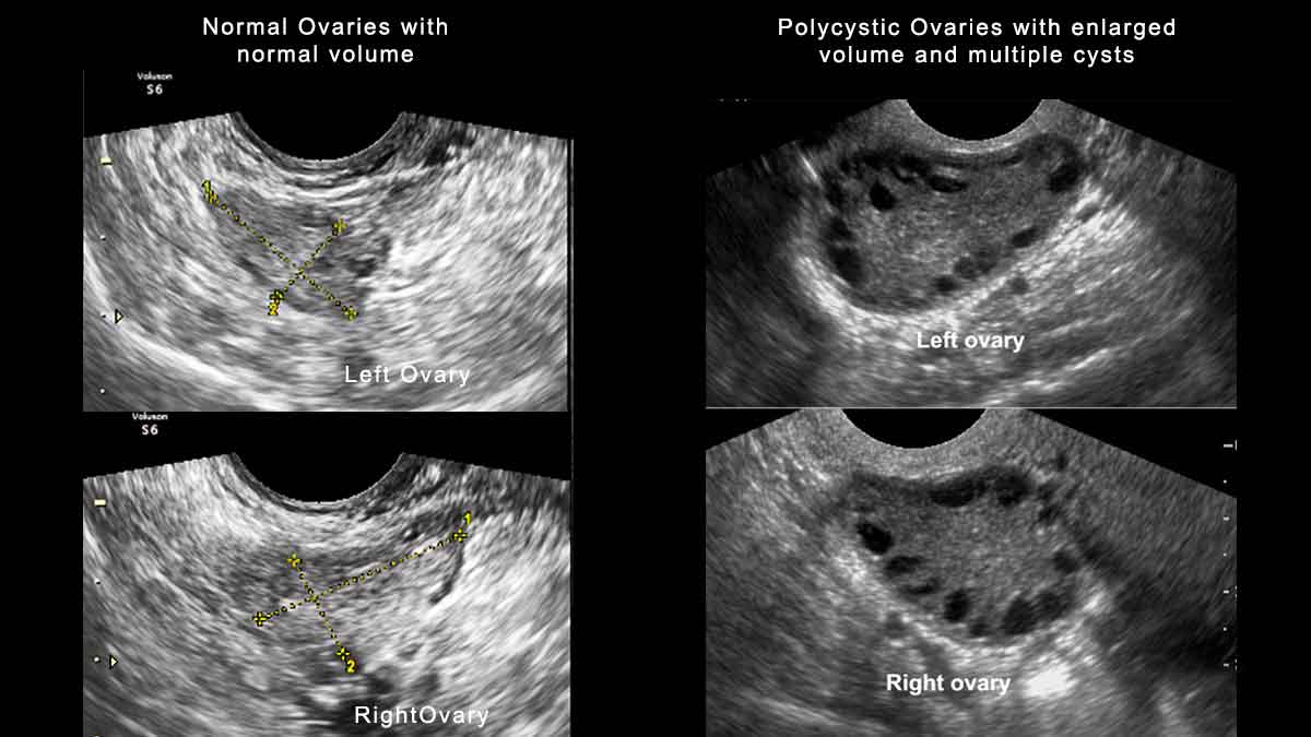 ovarian cyst spotting between periods