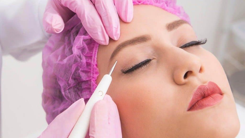 Plasma Pen Treatment for Under Eye Wrinkles