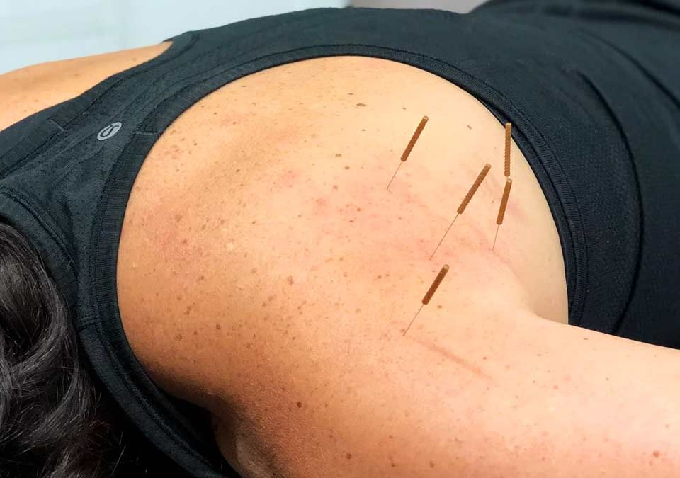 Dry Needling and its Benefits