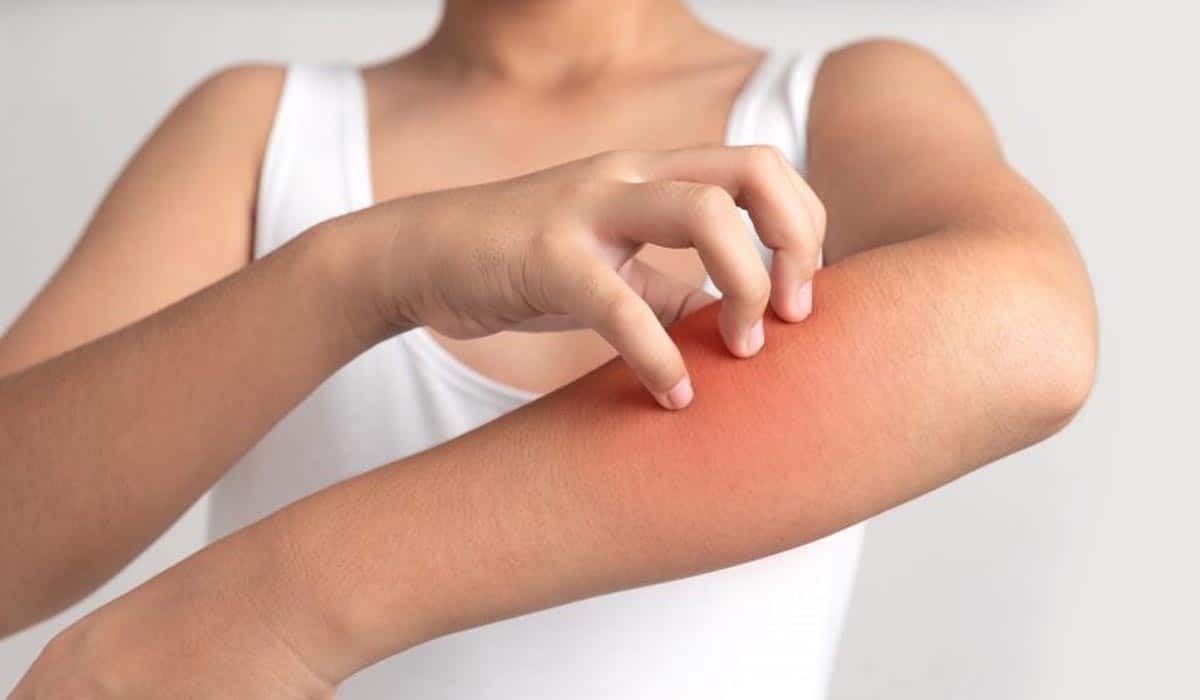 Menopause Eczema Causes, Treatments, Prevention, Home Remedies