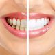 Things You Should Consider Before Getting Your Teeth Whitened