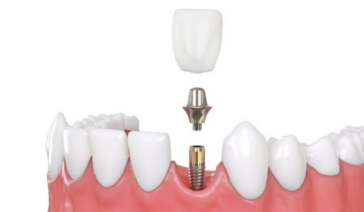 Bone augmentation dental implant