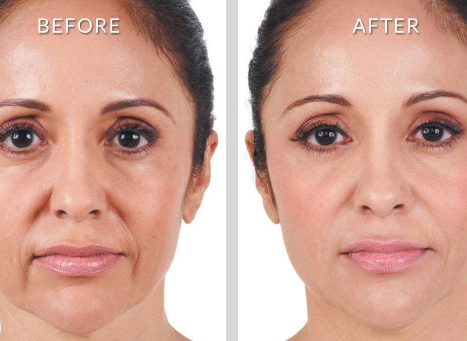 Non-Surgical Treatment for Nasolabial Folds and Marionette Lines