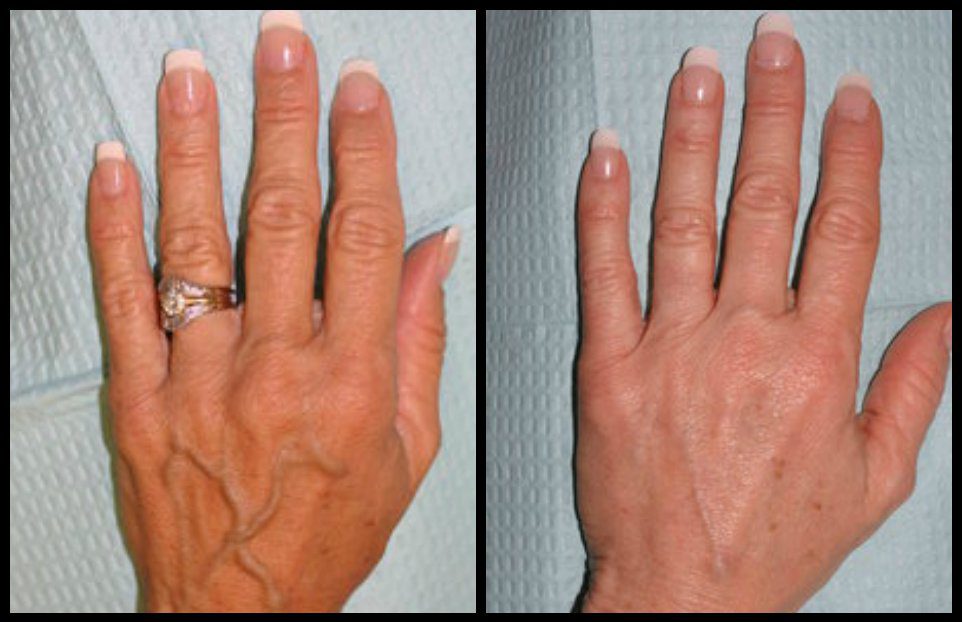 Fat transfer treatment for hand rejuvenation