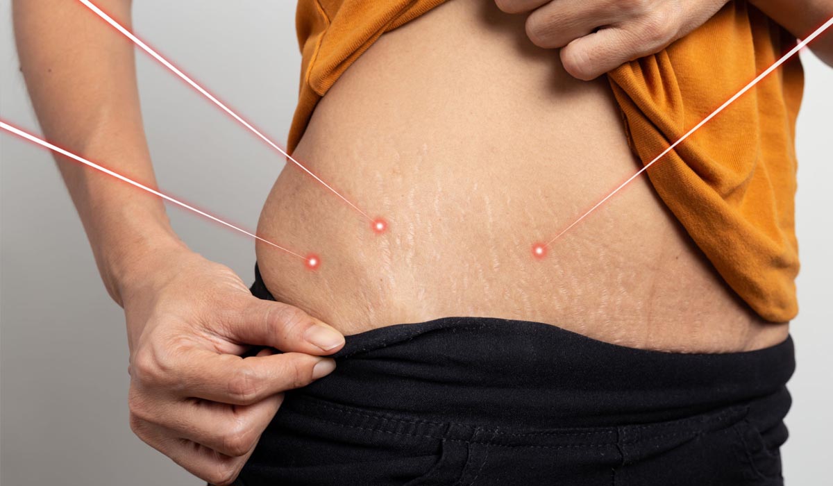 Laser therapy for stretch marks