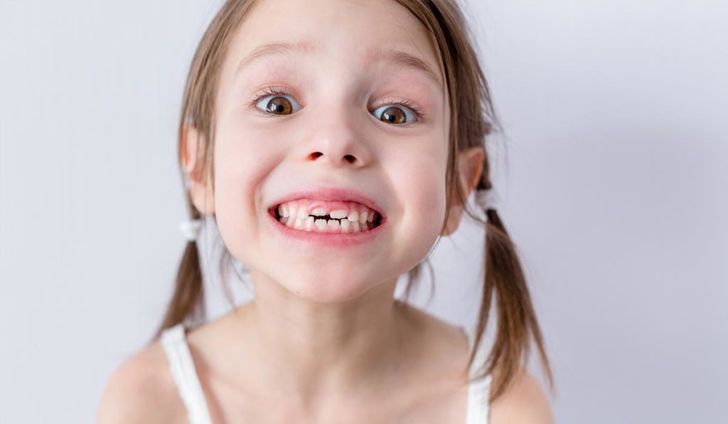Crooked Teeth in Children