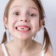 Crooked Teeth in Children