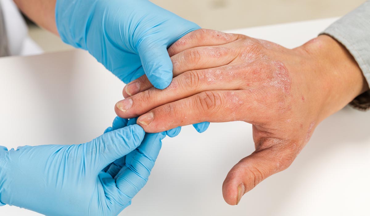 Eczema Causes Symptoms Treatment