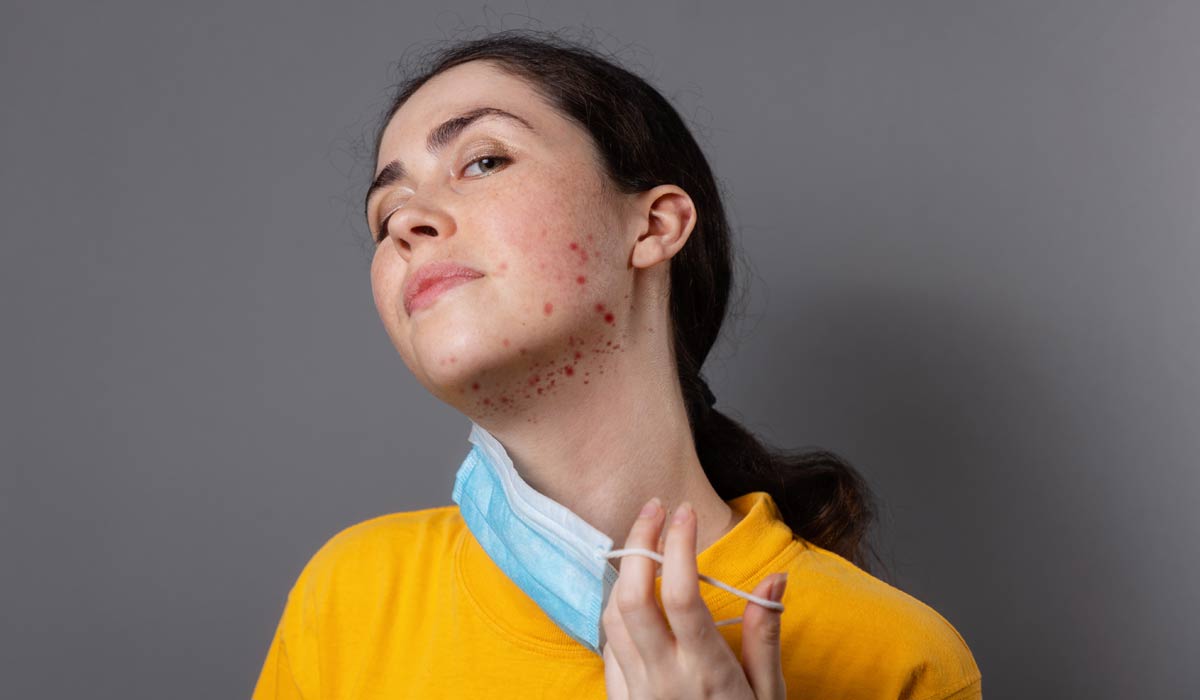 Acne and skin irritation