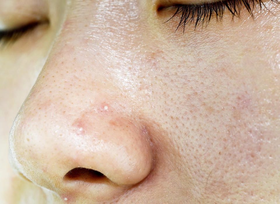 Whitehead pimples on nose