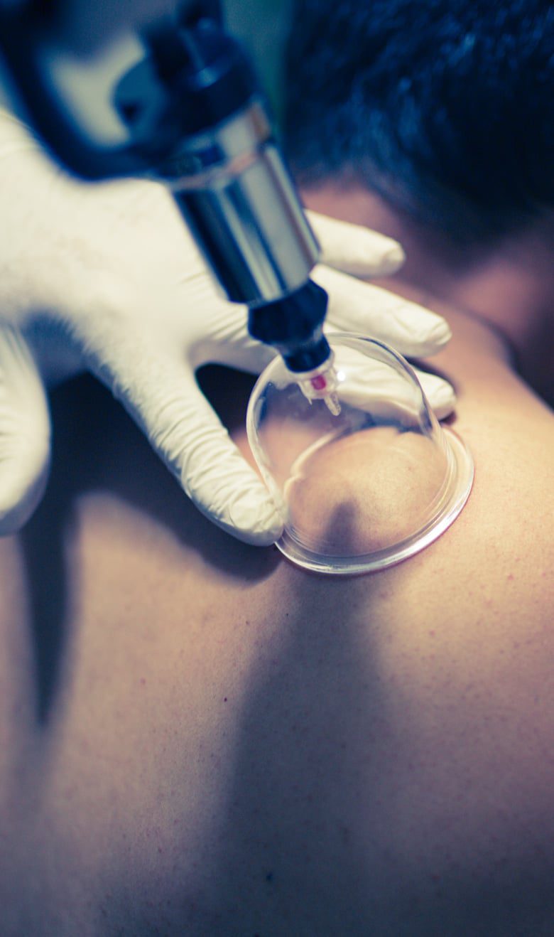 hijama hijama