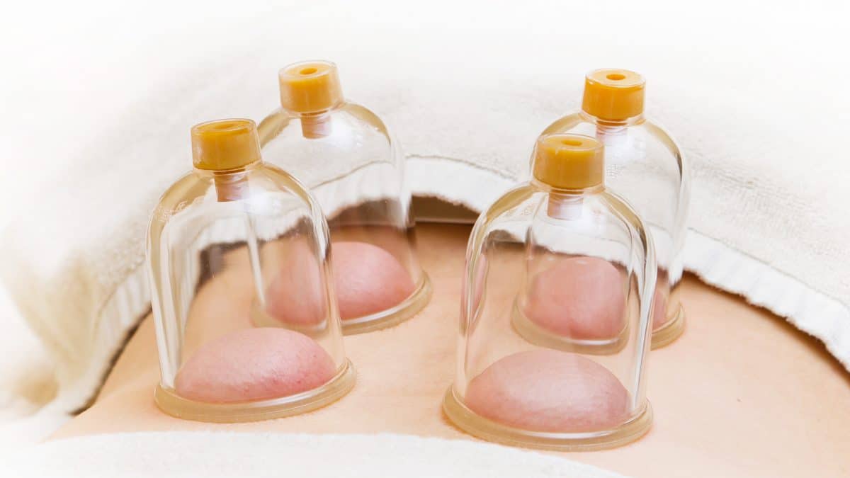 Cupping therapy for high blood pressure