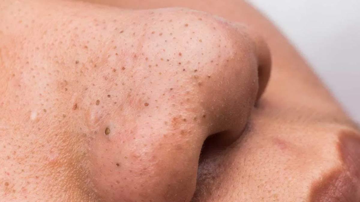 Acne Scar Removal Treatment, DualFunctional RF Technology