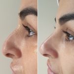 Before After Nose Job