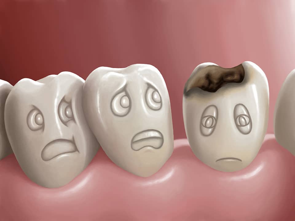 Tooth Decay Causes and Risk Factors