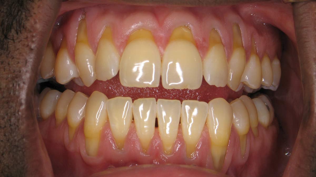 Receding Gums: Symptoms, Diagnosis, Causes, and Treatment