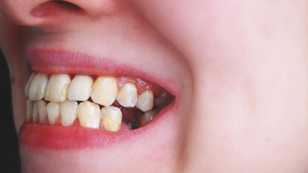 Receding Gums Symptoms Diagnosis Causes And Treatment