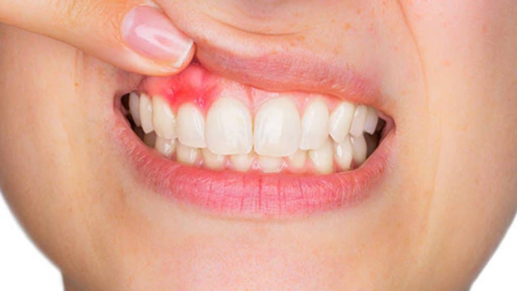 Receding Gums Causes and Treatment
