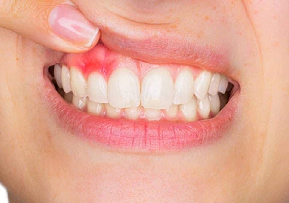 Receding Gums Causes and Treatment