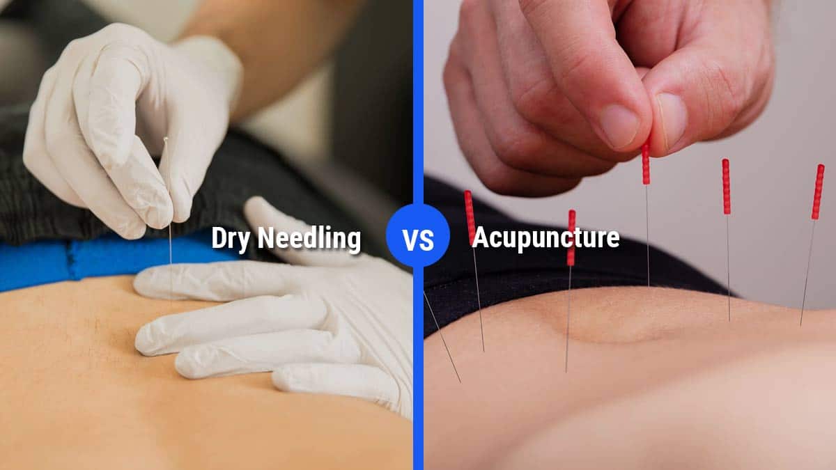 What is Dry Needling & How Can It Benefit You?