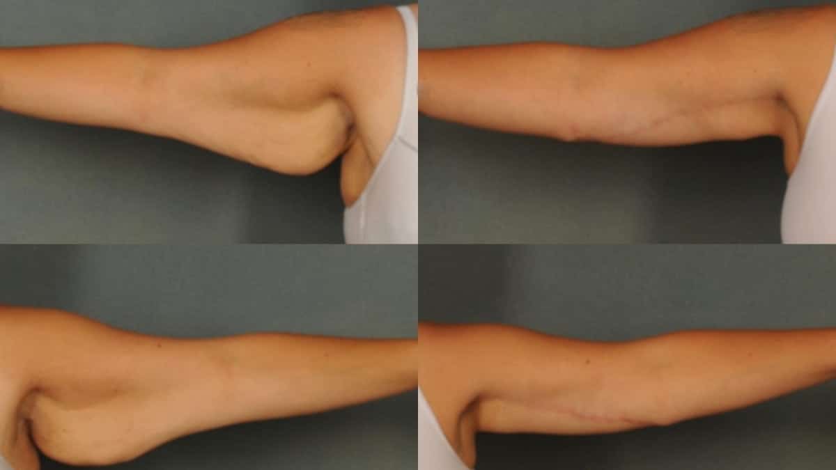 Non Surgical Arm Lifting Treatment in Dubai