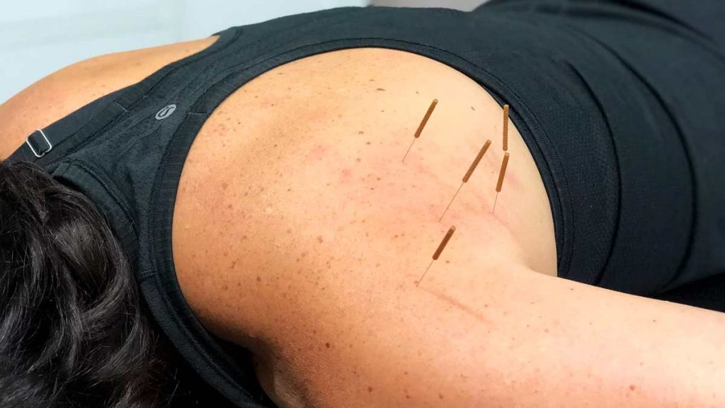 Dry Needling and its Benefits