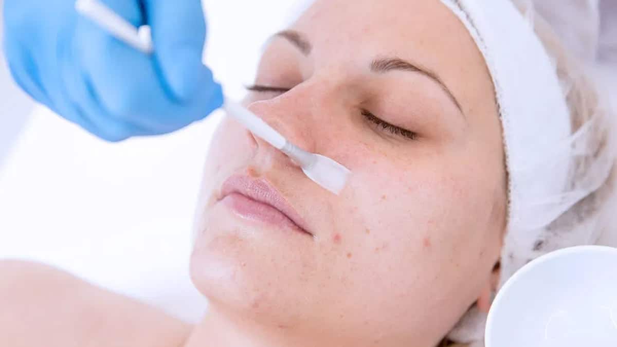 Chemical Peel for Acne Scars: Procedure and Benefits | 7DMC Dubai