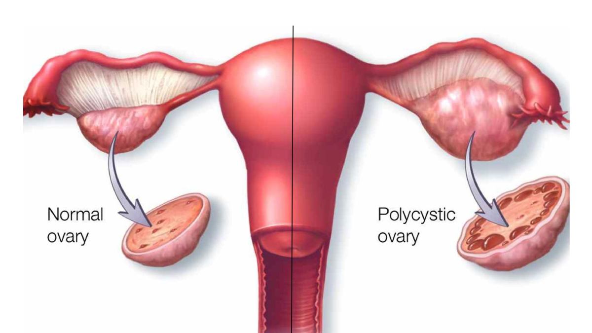 hpv causes pcos