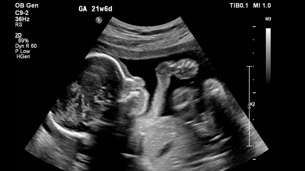 sonogram pregnant