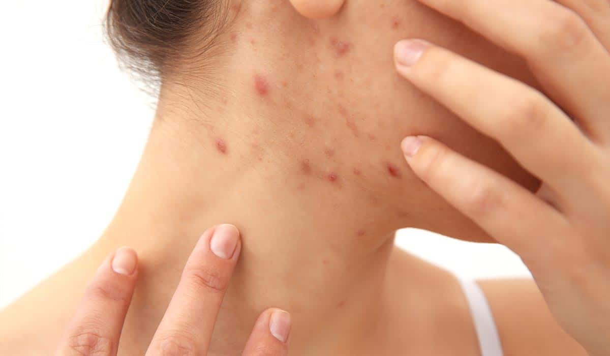 Acne During Pregnancy Causes Home Remedies Treatment