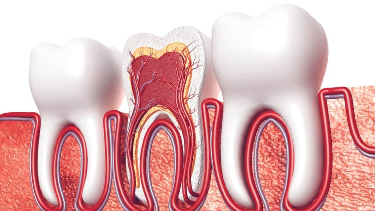 Root Canal Treatment (RCT)