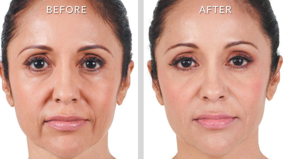 Non-Surgical Treatment for Nasolabial Folds and Marionette Lines