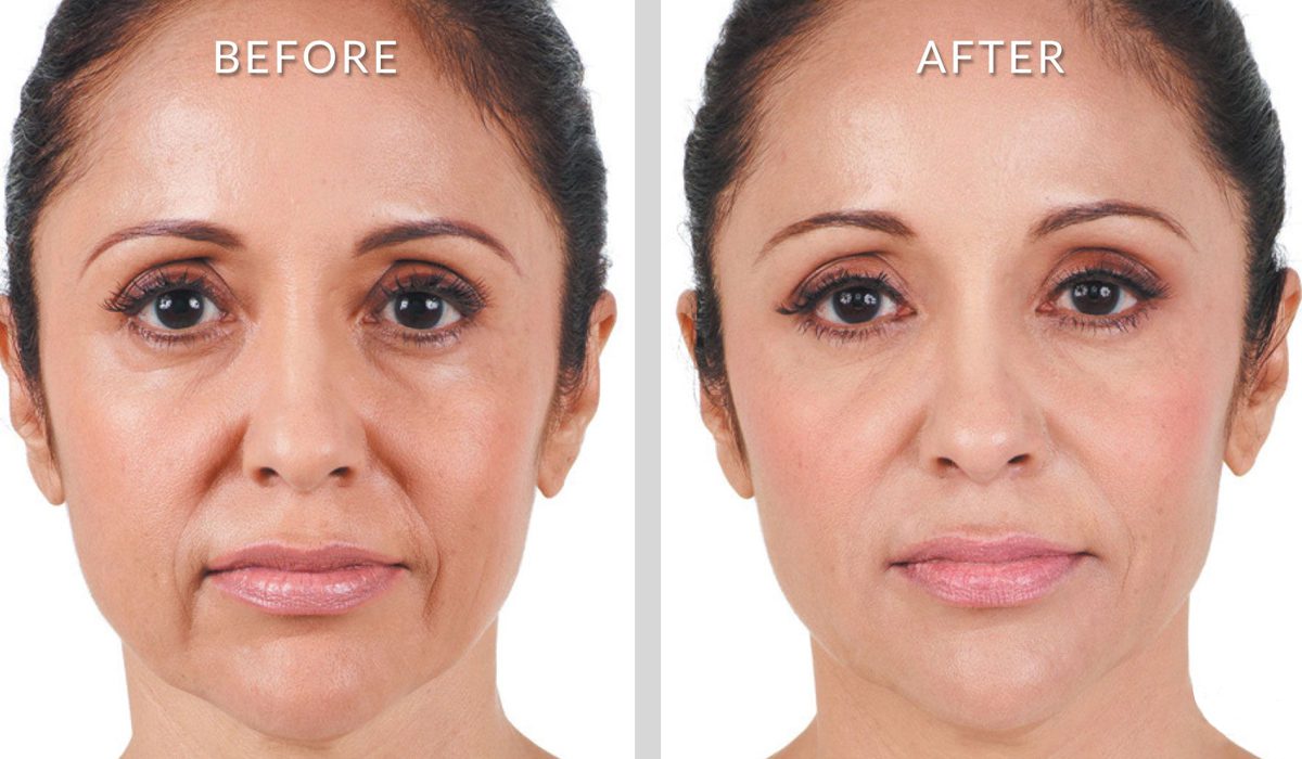 NonSurgical Treatment for Nasolabial Folds, Lines