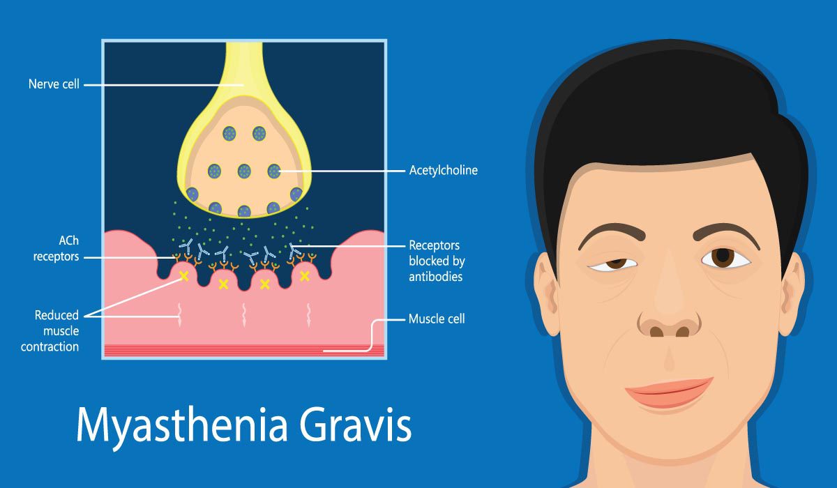 Bell palsy treatment with Botox UAE