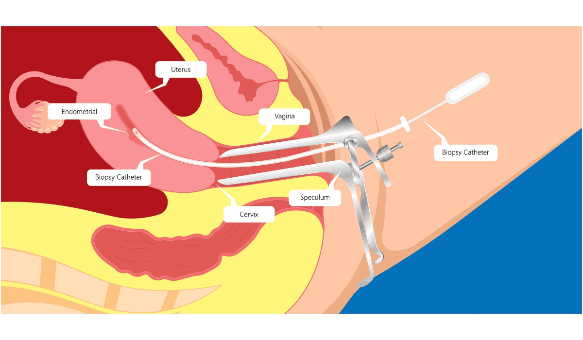 Dilation and Curettage