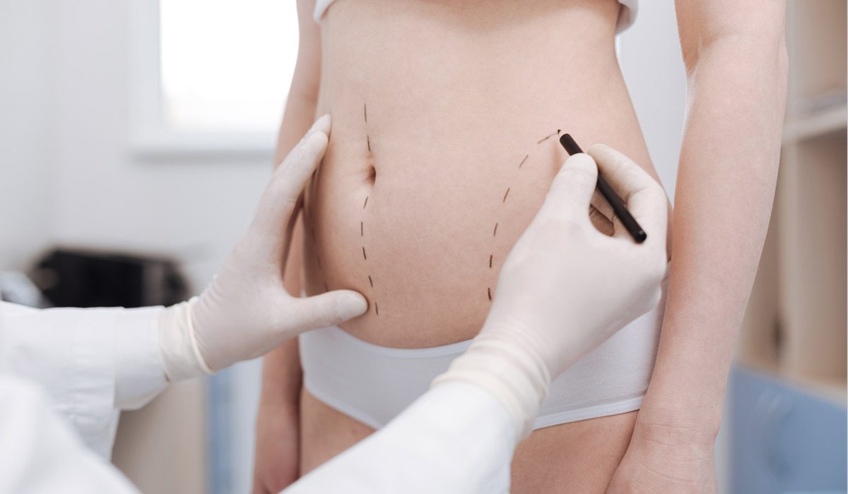 Liposuction