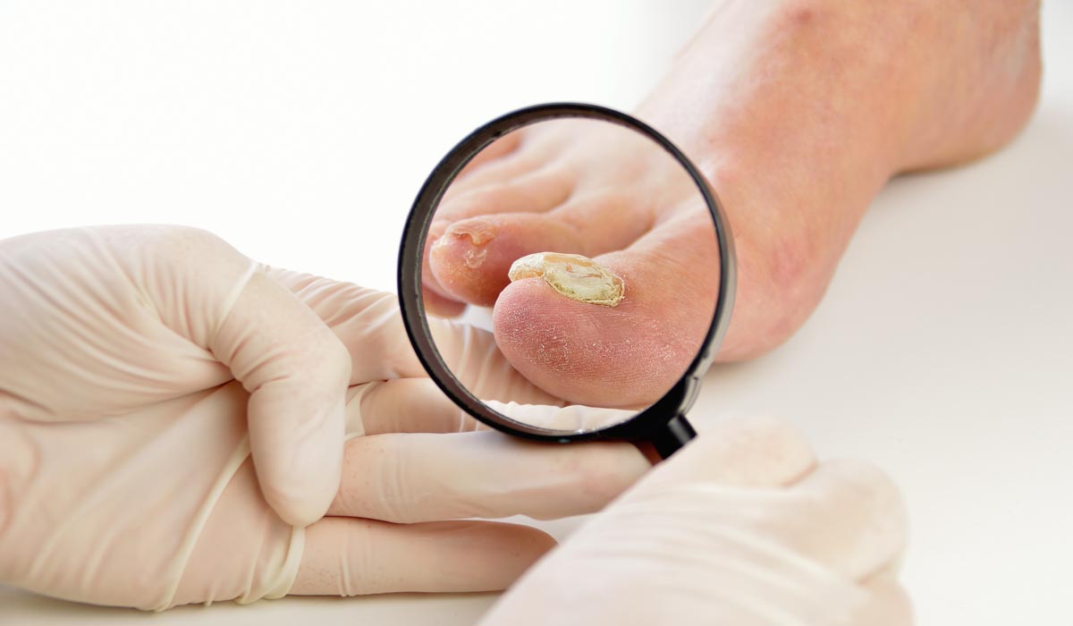 Common Nail Conditions  Diagnosis and Treatment Options