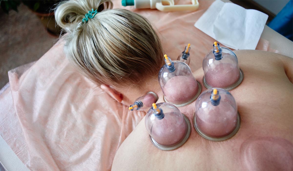 Amazing Benefits of Hijama