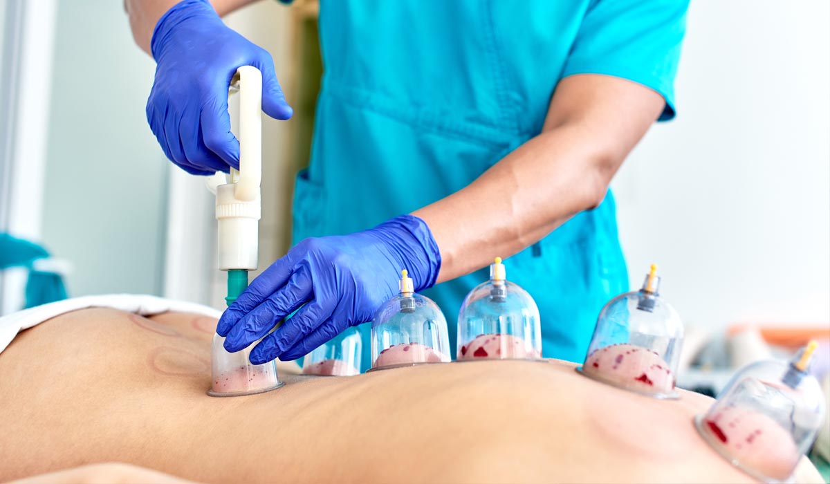 7 Amazing Benefits of Hijama and Cupping Therapy | 7DMC Dubai