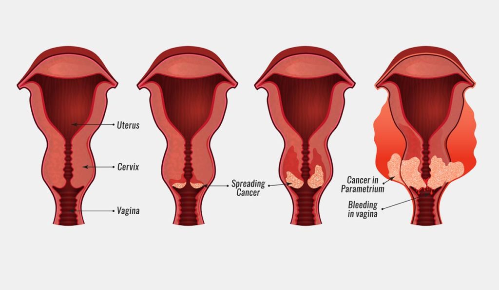 Cervical Dysplasia Symptoms Causes Treatments Prevention