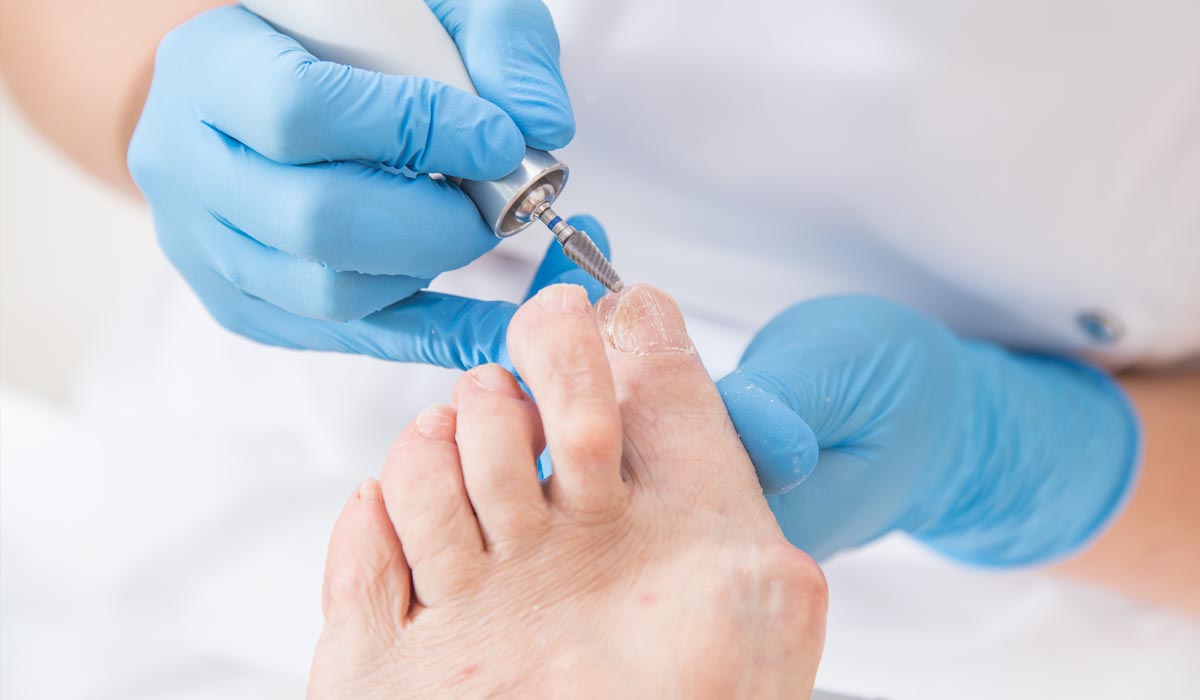 What is an Ingrown Toenail and How to Treat it?