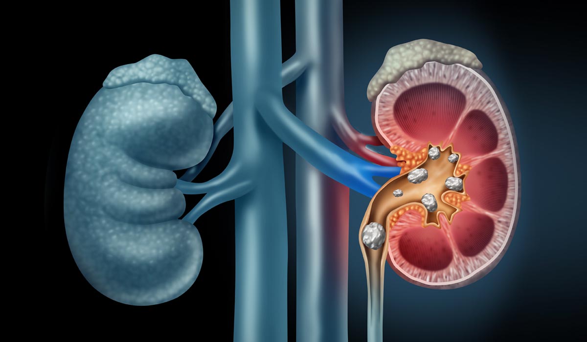 Kidney Stones – Causes and Prevention