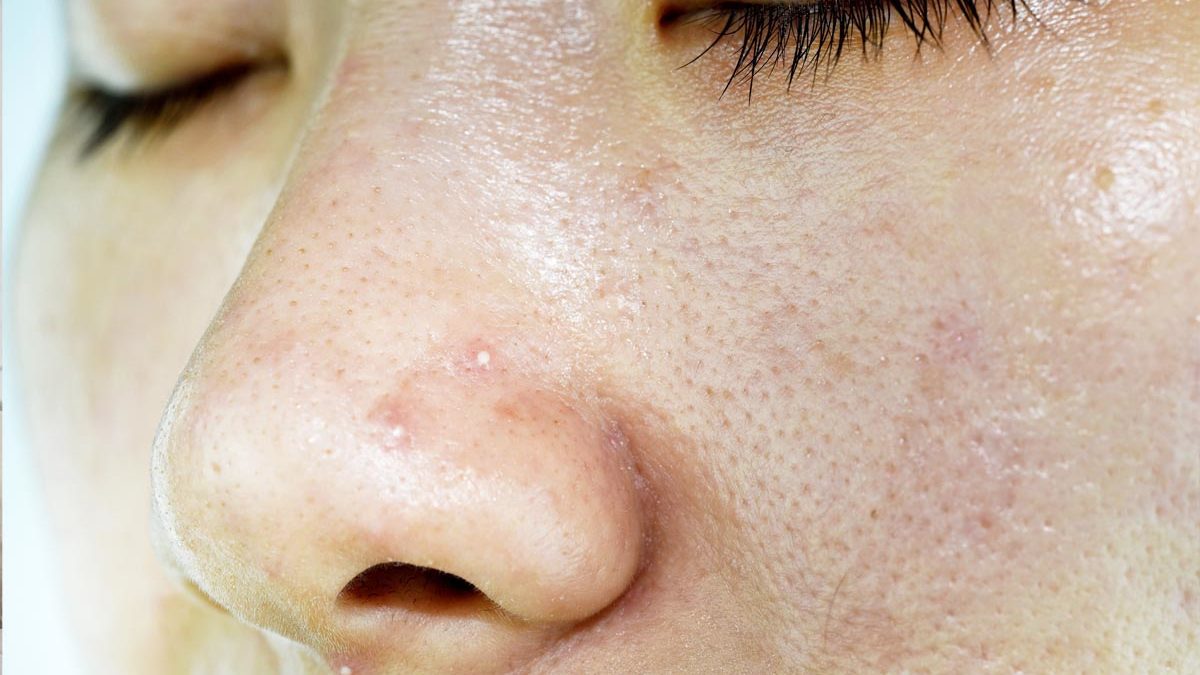 Whitehead pimples on nose